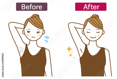 ワキのムダ毛の脱毛ビフォーアフターイラスト Stock Illustration Adobe Stock ワキのムダ毛の脱毛ビフォーアフターイラスト Stock Illustration Adobe Stock