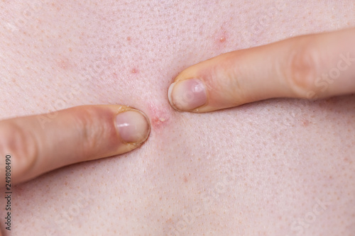 Woman dealing with pimples red spots