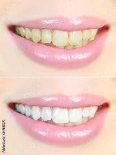 Teeth whitening effect, before and after, vertical