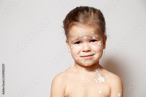 Closeup face cute little girl with varicella virus or chickenpox bubble rash, conjunctivitis, sore eyes, red spots covered zinc lotion calamine. Concept of infectious quarantine in kindergarten