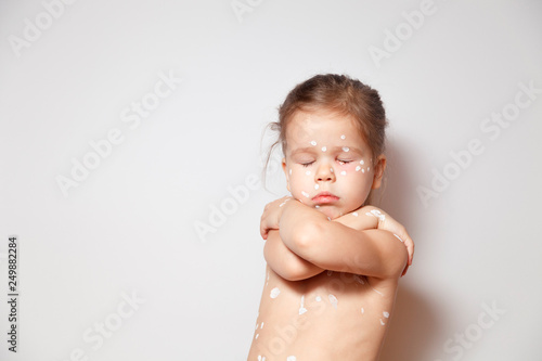 Fotografie Closeup cute little girl with varicella virus or chickenpox bubble rash, conjunctivitis, sore eyes, red spots covered zinc lotion calamine