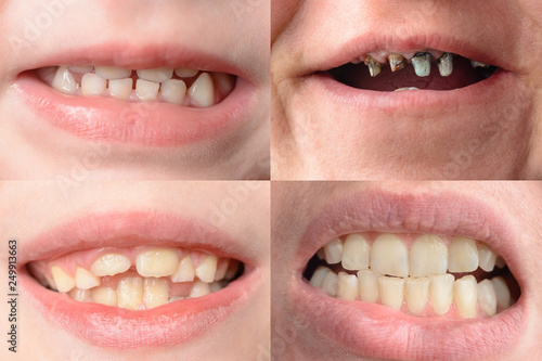 A set of four photographs of people with curves and rotten teeth