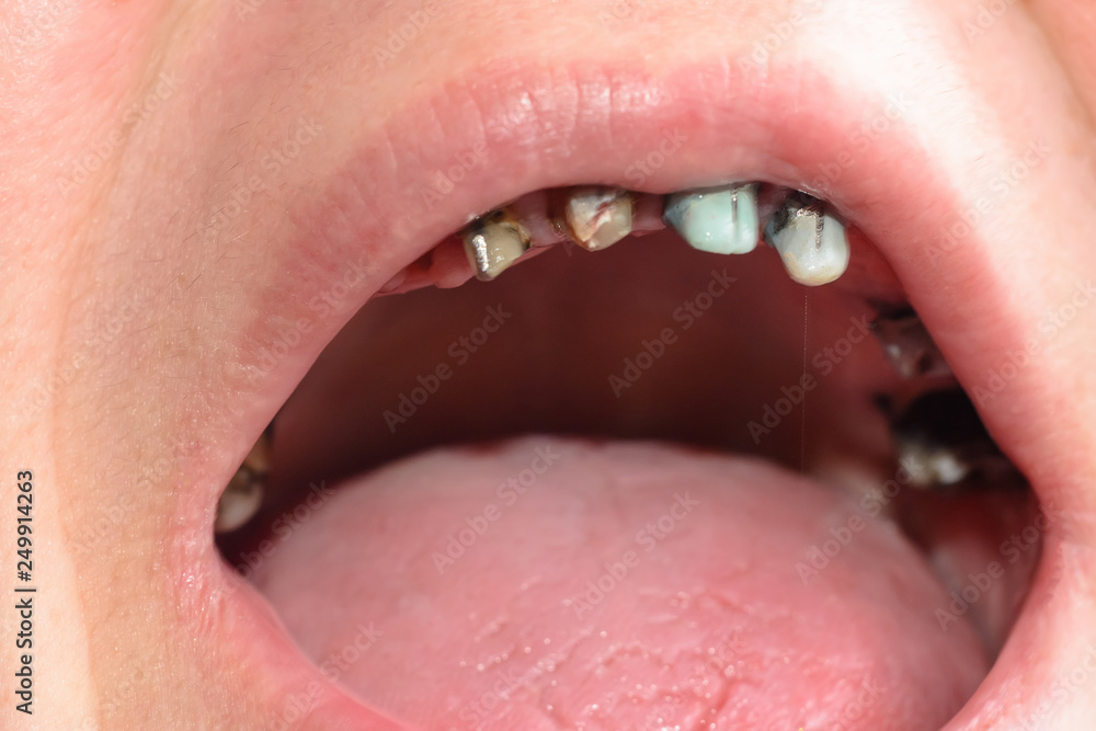Obraz premium Close-up of a woman's face with rotten and dying teeth