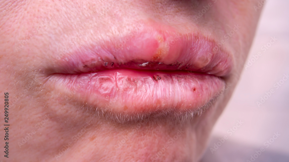 Obraz premium herpes on the female lips macro. Colds. Close-up.