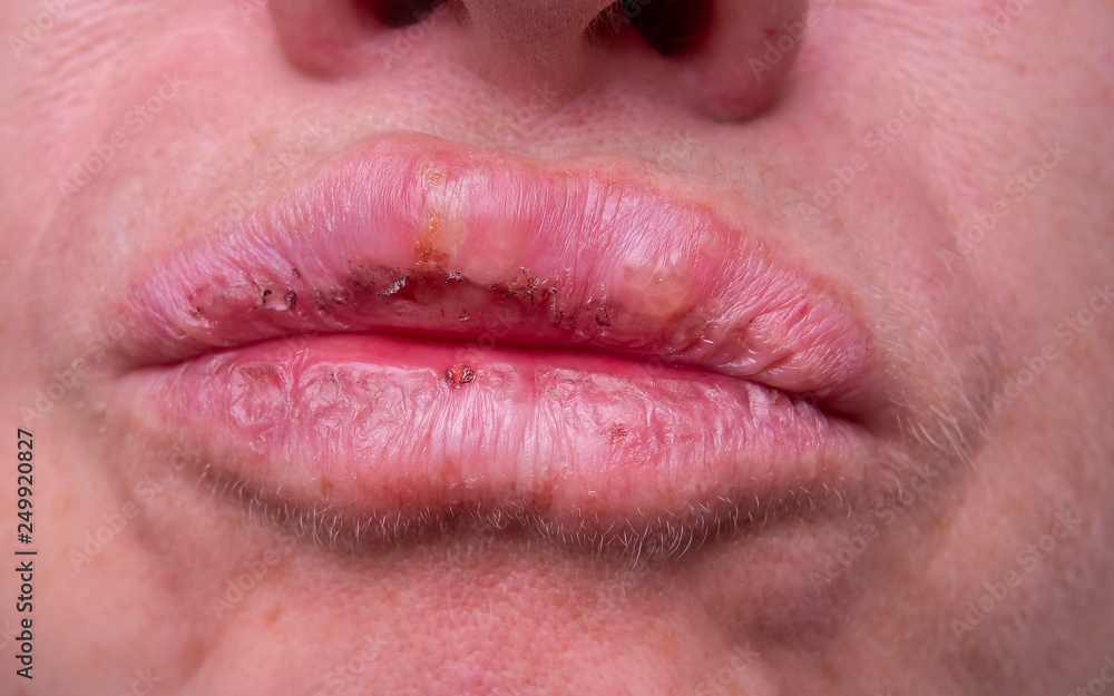 Fototapeta premium herpes on the female lips macro. Colds. Close-up.
