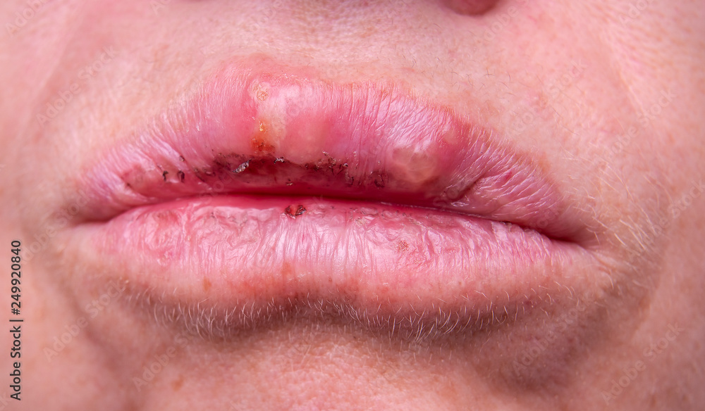 herpes on the female lips macro. Colds. Close-up.