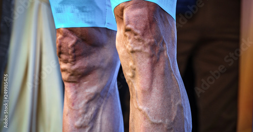 Foto Cyclist legs with varicose and protruded veins, front view