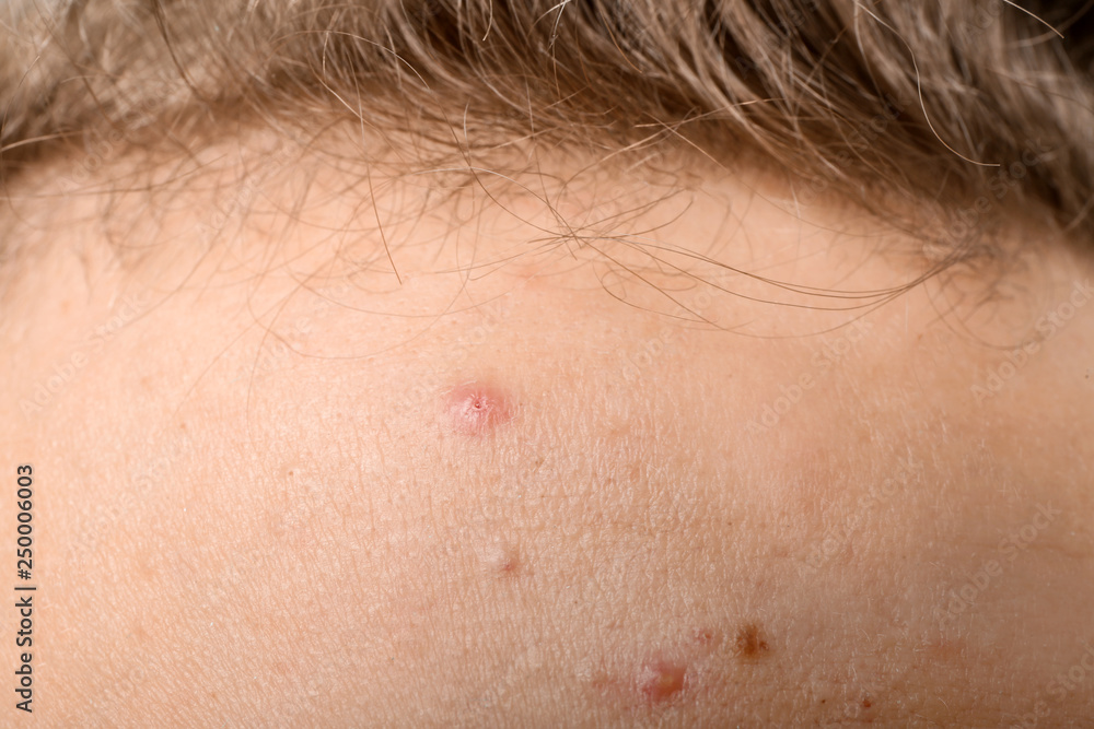 Teenager with acne problem, closeup Teenager with acne problem, closeup