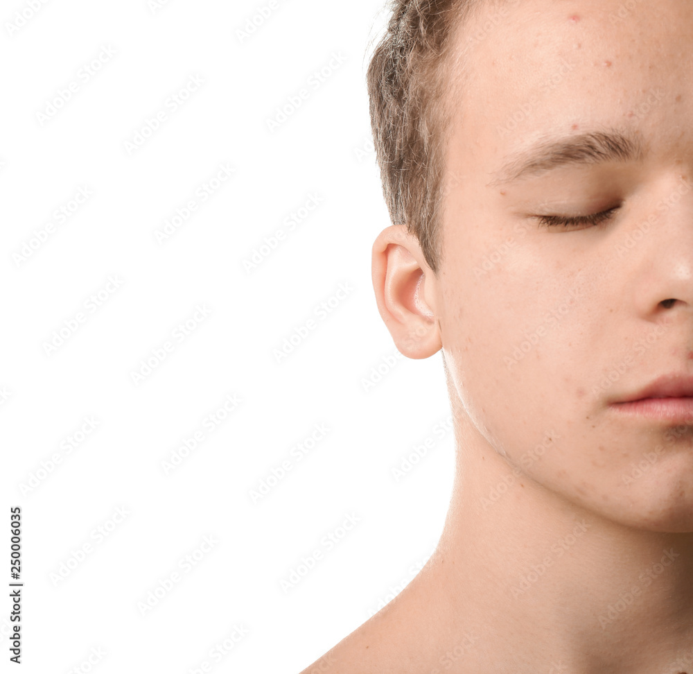 Fototapeta premium Teenager with acne problem on white background