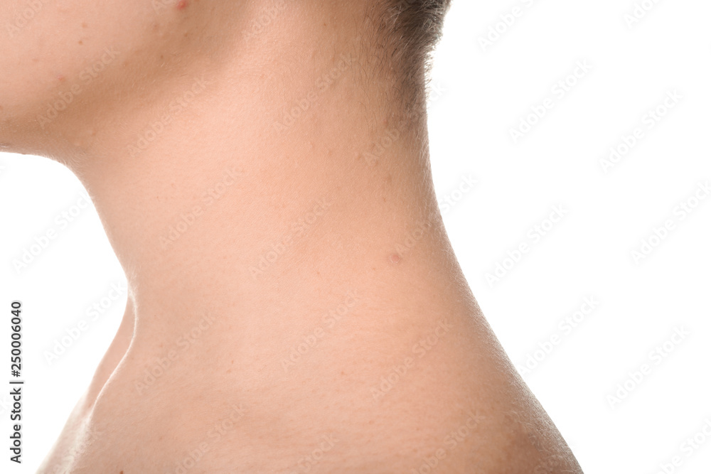 Teenager with acne problem on white background, closeup Teenager with acne problem on white background, closeup