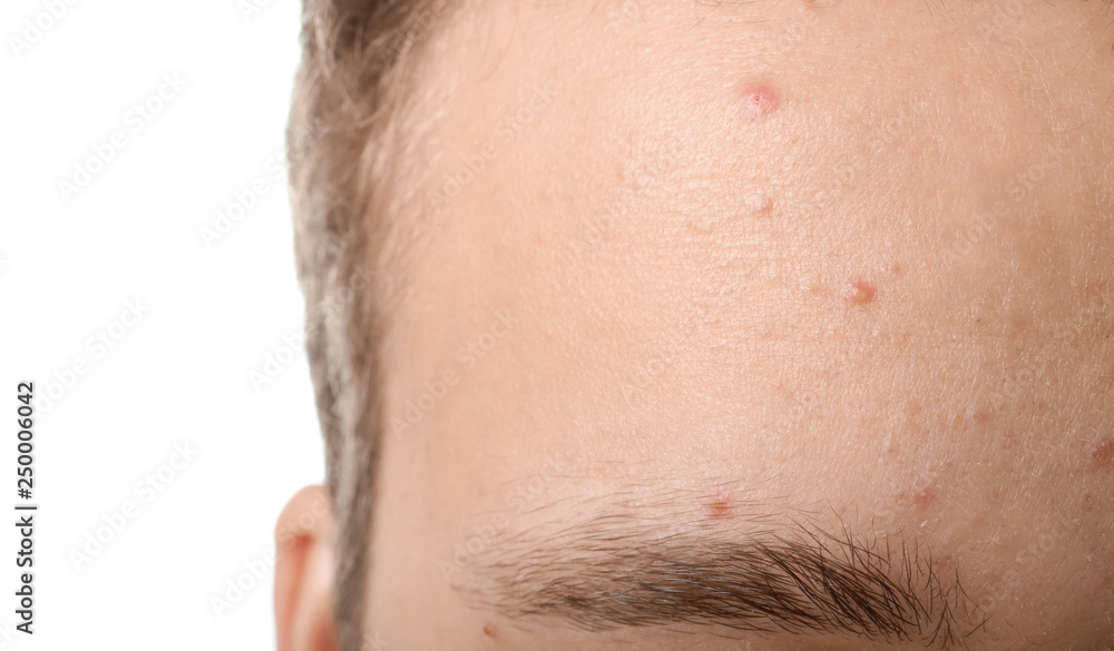 Fototapeta premium Teenager with acne problem, closeup