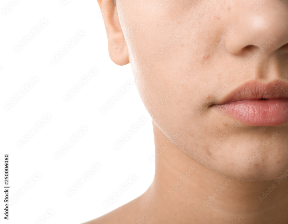 Girl with acne problem on white background, closeup Girl with acne problem on white background, closeup