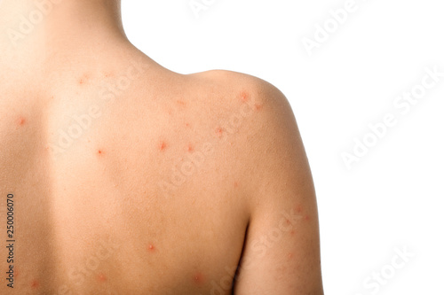 Girl with acne problem on white background