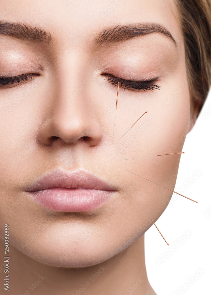 Woman undergoing acupuncture treatment. - obrazy, fototapety, plakaty 