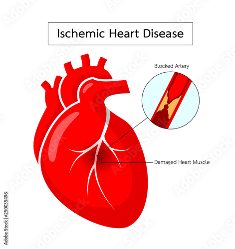 Human heart with Ischemic Heart Disease info graphic.. Blocked artery, damaged heart muscle. Heart awareness concept. Illustration isolated on white background.