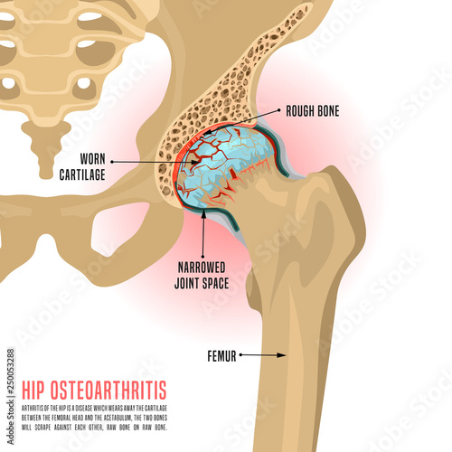 Hip Osteoarthritis Infographic