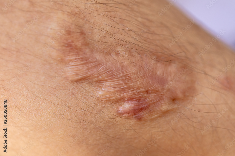 A scar is an area of fibrous tissue that replaces normal skin after an injury on skin. 