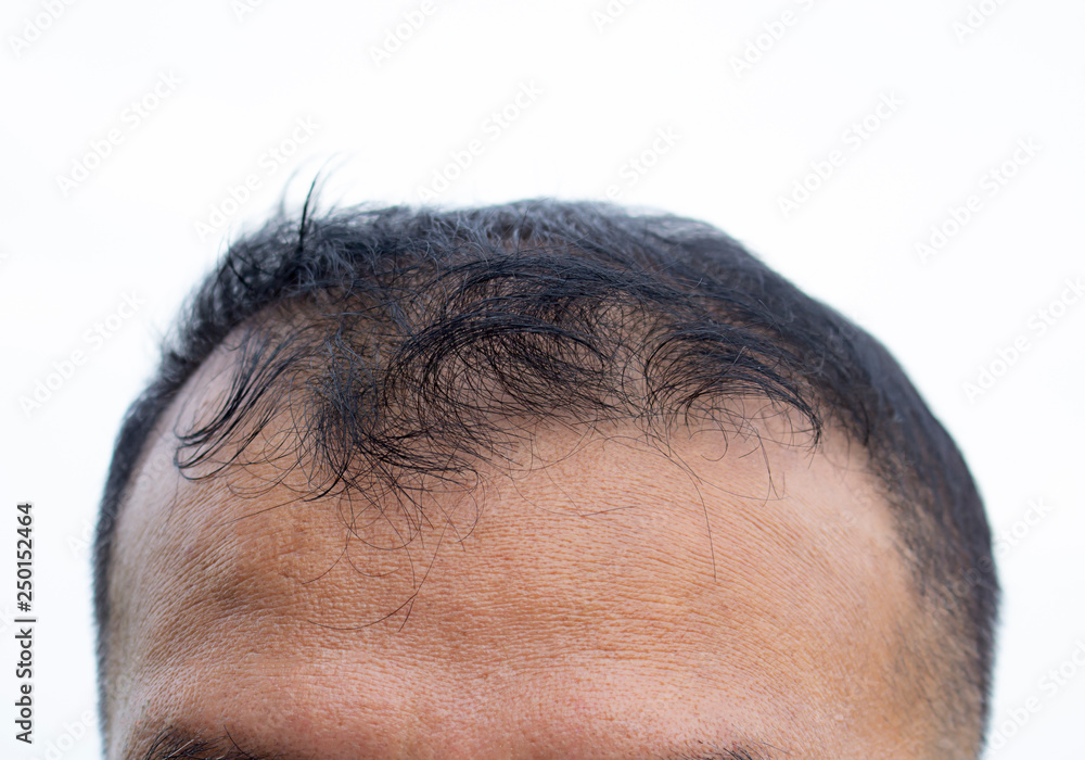 Hair loss front side of asia man. Hair loss front side of asia man.
