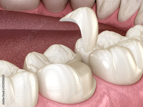 Onlay ceramic crown fixation over tooth. Medically accurate 3D illustration of human teeth treatment