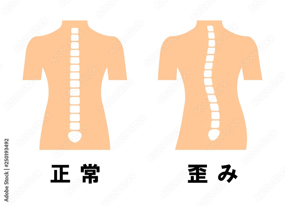 正常な背骨と歪んだ背骨 Stock イラスト Adobe Stock 正常な背骨と歪んだ背骨 Stock イラスト Adobe Stock