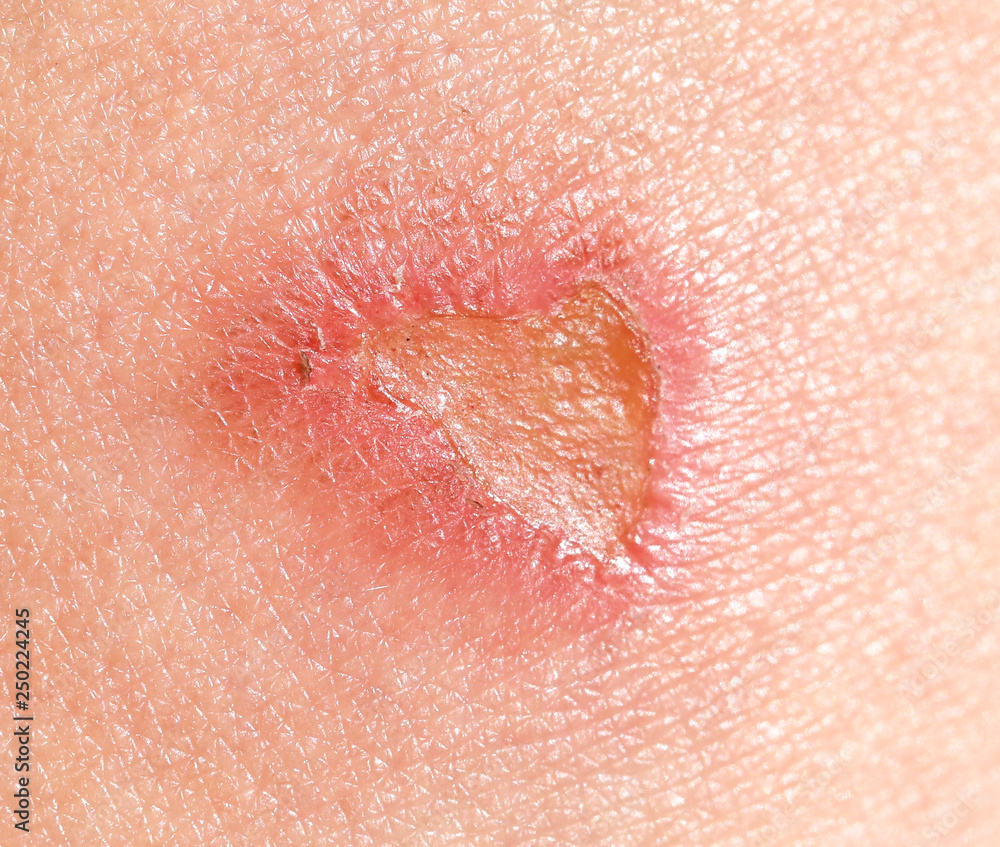 Fototapeta premium Wound on human skin.