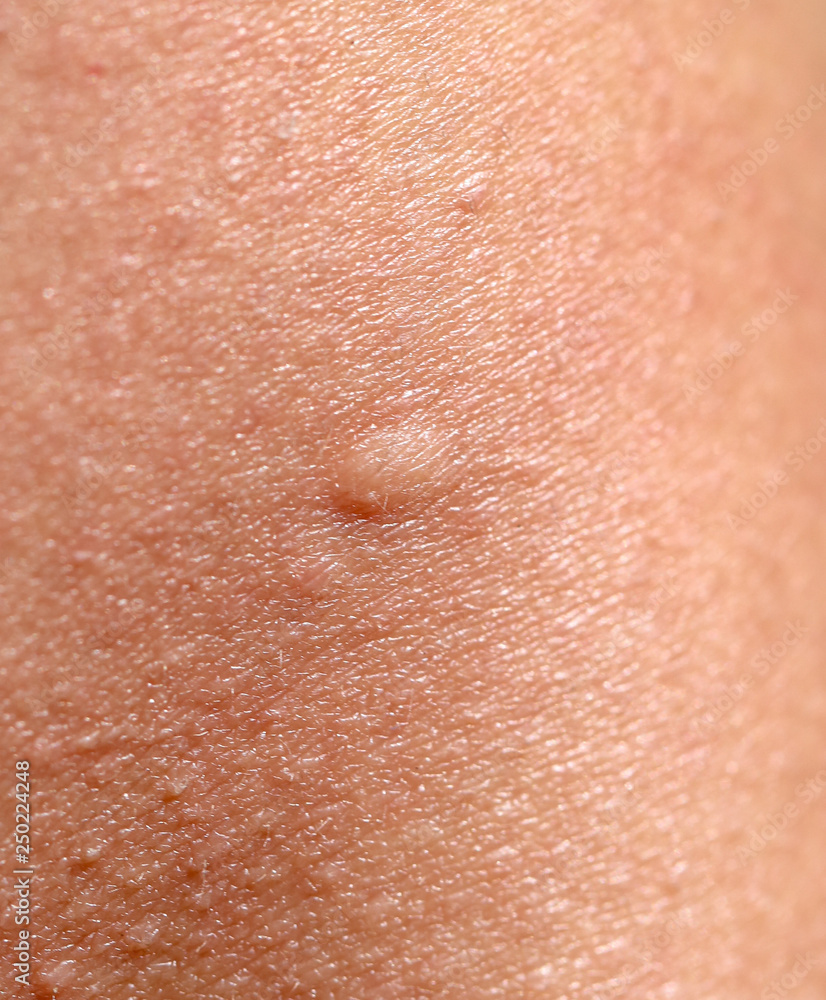 Fototapeta premium Bee sting on human skin.
