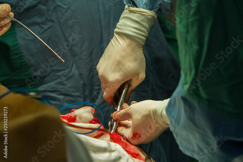 Close-up of a surgeon's hand with tongs breaking a skull bone.