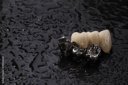 E-max pressed ceramic bridge and metal crown