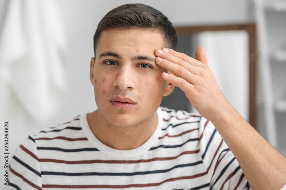 Portrait of young man with acne problem at home Portrait of young man with acne problem at home