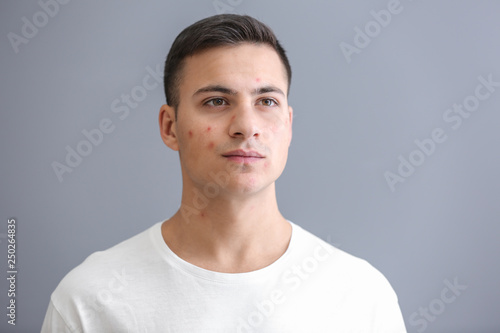 Portrait of young man with acne problem on grey background © Pixel-Shot