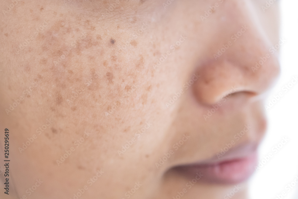 Obraz premium freckle on asian woman skin