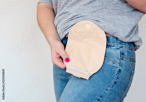 Front view on colostomy pouch in skin color attached to young woman patient. Close-up on ostomy bag after surgery. Colon cancer treatment.