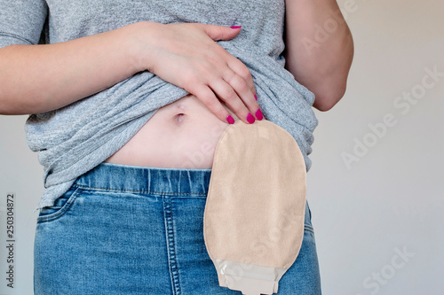 Front view on colostomy pouch in skin color attached to young woman patient. Close-up on ostomy bag after surgery. photo