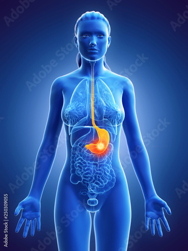 3d rendered medically accurate illustration of a womans stomach tumor