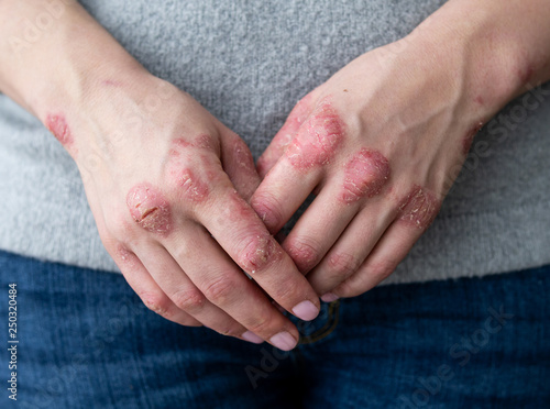 Cracked, flaky skin on the palm of your hand. Dermatological problems of psoriasis. Hard, horny and cracked skin on the finger in a man's hand. Psoriasis, allergy