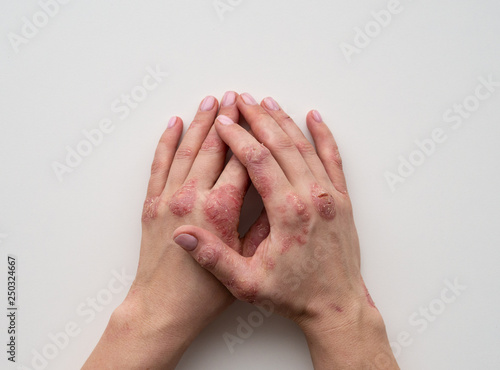 Psoriasis skin. Closeup of rash and scaling on the patient's skin. The concept of chronic disease treatment. Dermatological problems. Hard, horny and cracked skin in woman's hands. Dry skin. Isolated.