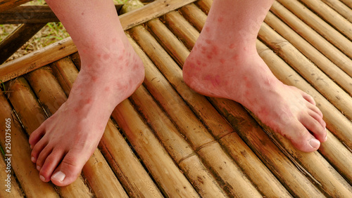 Фотография Close up red rash of man’s feet
