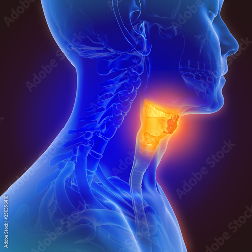 3d illustration of throat cancer photo