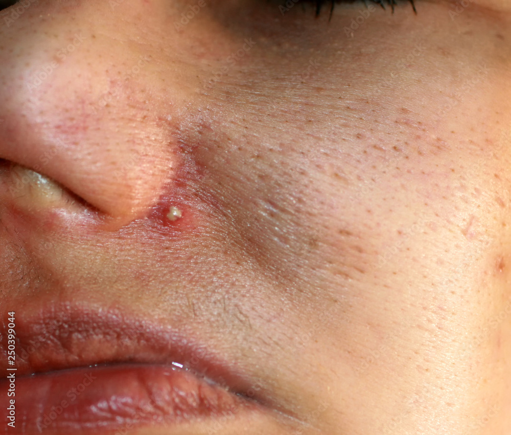 Inflamed skin of the face. Acne. Pimple purulent on the nose. Inflamed skin of the face. Acne. Pimple purulent on the nose.