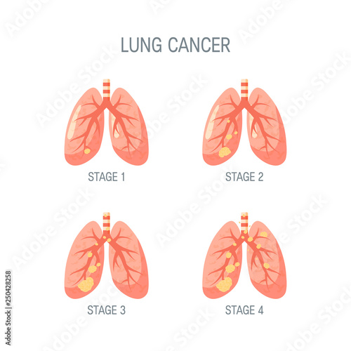 Lung cancer vector concept in flat style
