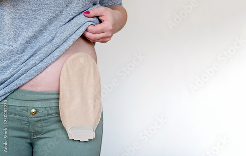 Front view on colostomy pouch in skin color attached to woman patient. Close-up on ostomy bag after surgery. Colon cancer treatment. Copy space.