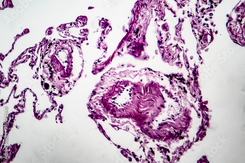 Histopathology of lung emphysema, light micrograph, photo under microscope showing enlargement of air spaces in lung tissue and destruction of alveolar septa