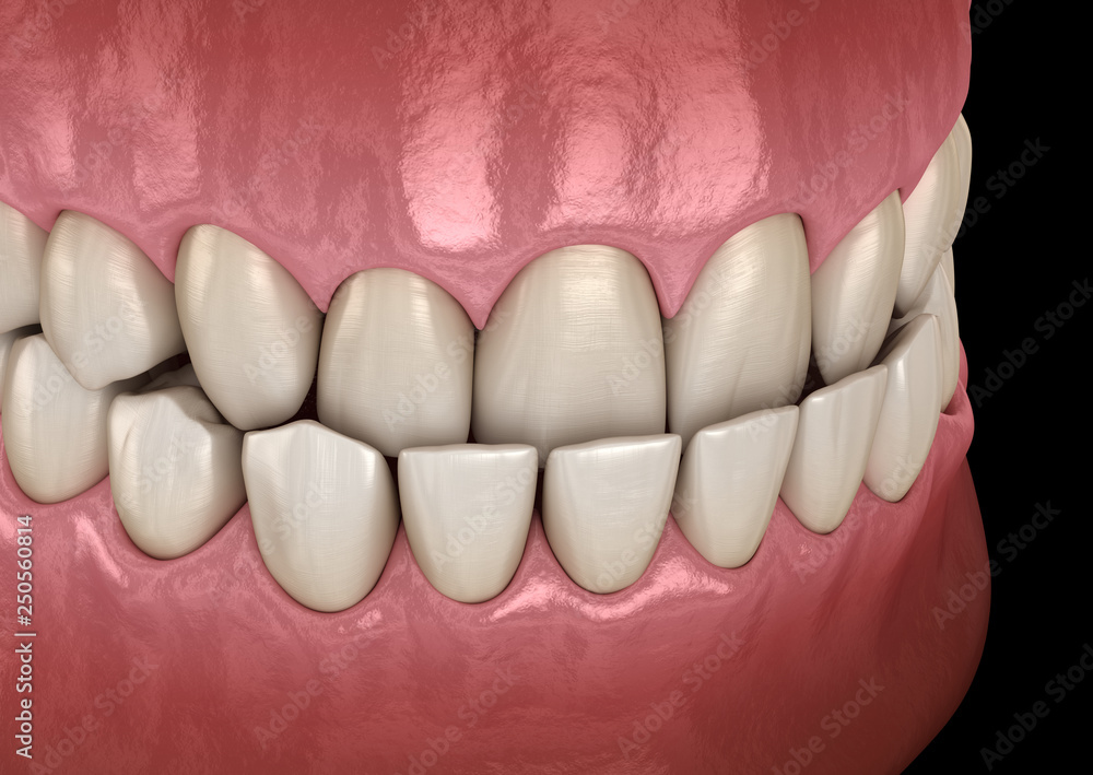 Underbite dental occlusion ( Malocclusion of teeth ). Medically accurate tooth 3D illustration