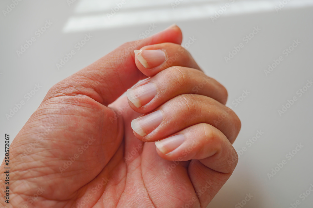 How I Stopped Biting My Fingers and Nails After 15 Years