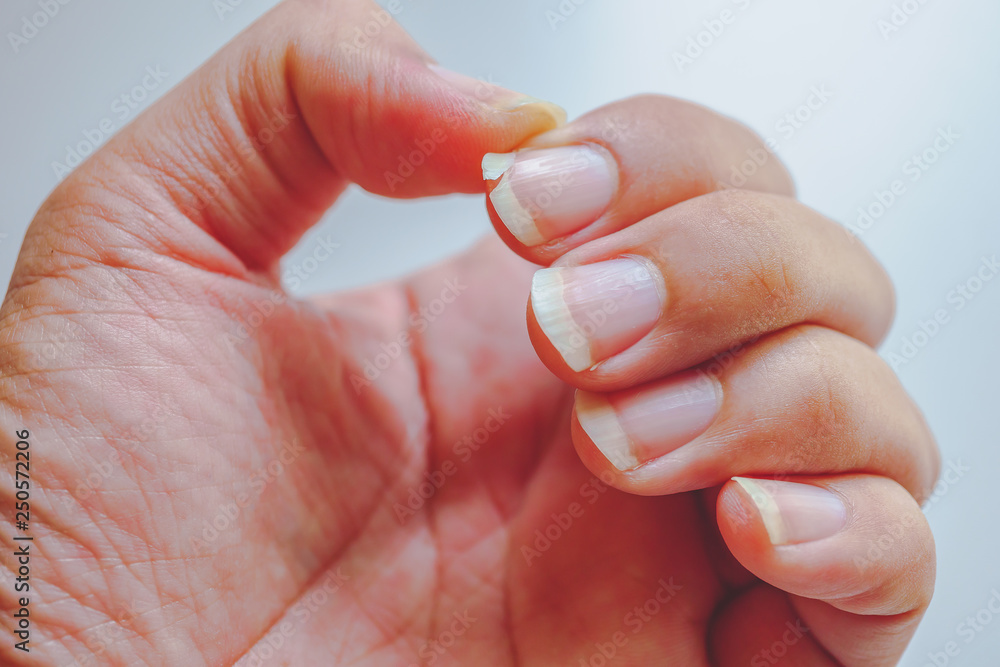 Finger Hurts When Bent gut Doesn't Swell: 5 Causes | Excel PTExcel Sports PT