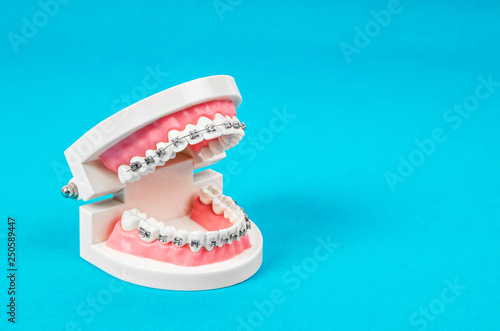 Tooth model with metal wire dental braces.