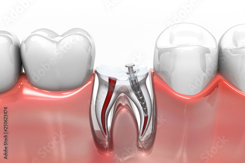 Root canal treatment process. 3d render photo