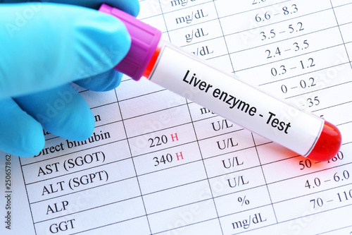 Abnormal high liver enzyme test result with blood sample tube photo