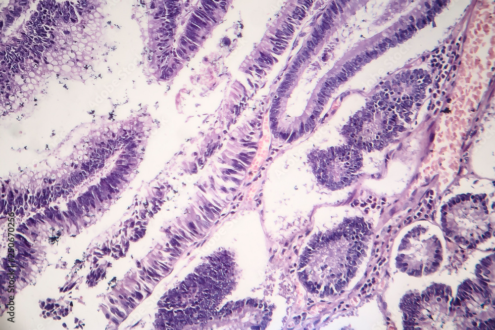 Histopathology of intestinal adenoma, light micrograph, photo under ...