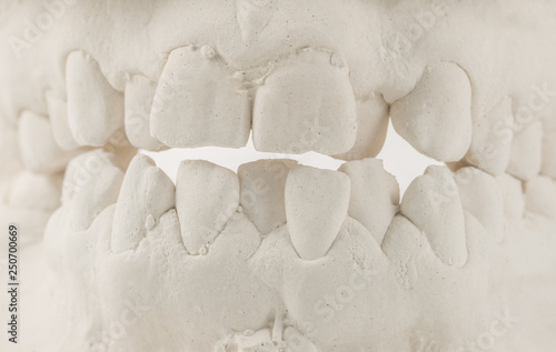 Dental casting gypsum model of human jaws. Crooked teeth and distal bite. Shots were made before treatment with braces . Technical shots on gray background photo